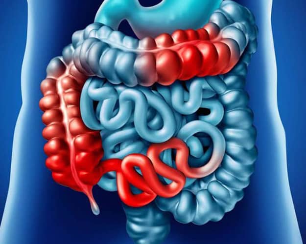 Maladies Inflammatoires de l’Intestin et Virus d’Epstein-Barr : Un Lien Sous-Évalué ?